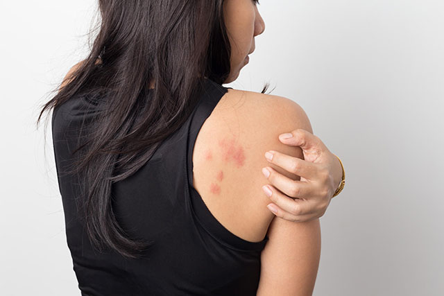 ダニに刺された女性